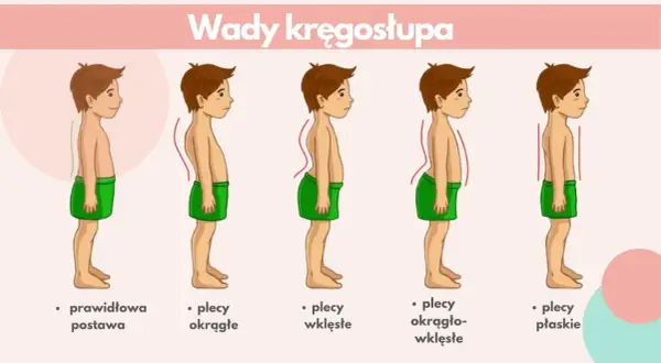 Ilustracja pokazuje wady kręgosłupa: plecy okrągłe, wklęsłe, okrągło-wklęsłe i płaskie, w porównaniu do prawidłowej postawy. Kifoza to jedna z wad.