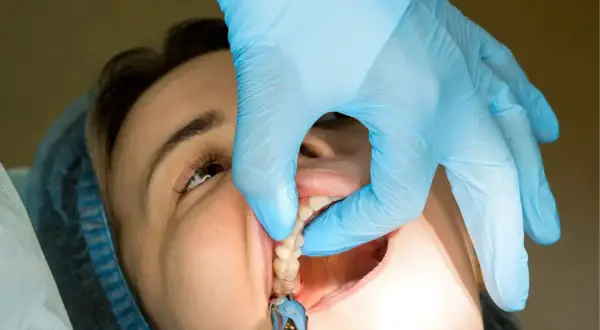 Dentysta w niebieskiej rękawiczce delikatnie podtrzymuje policzek pacjentki, pokazując zęby. Czas, po jakim zdejmuje się szwy, zależy od zabiegu.