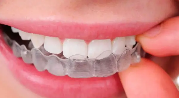 Denti allineati con Invisalign, una scelta discreta anche in gravidanza per un sorriso perfetto.