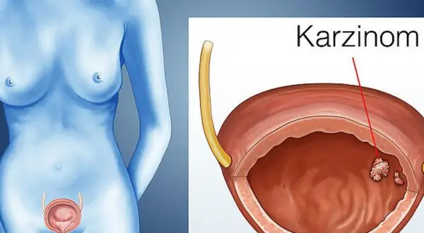 Illustration zeigt eine weibliche Figur und eine Blase mit einem Karzinom. Mögliche blasenkrebs symptome werden hier visuell dargestellt.