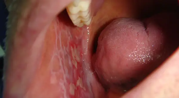 Lesioni biancastre e arrossate all'interno della bocca, possibili sintomi di lichen planus da stress.