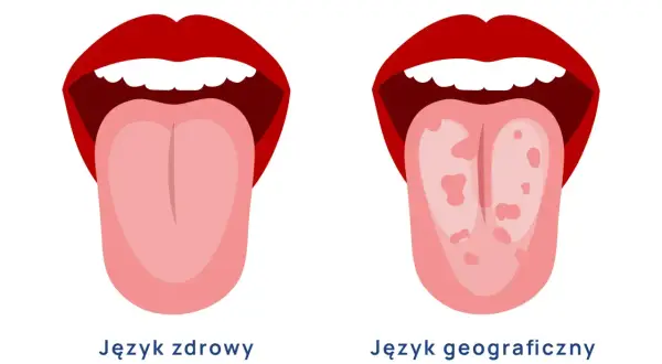 Dwa języki: jeden zdrowy, gładki, drugi z plamami, przypominający mapę. To obraz języka geograficznego.
