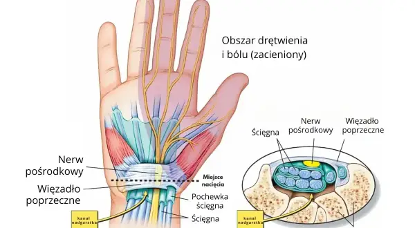 Anatomia dłoni: nerw pośrodkowy, ścięgna i więzadło poprzeczne w kanale nadgarstka. Ilustracja pokazuje obszar drętwienia i bólu.