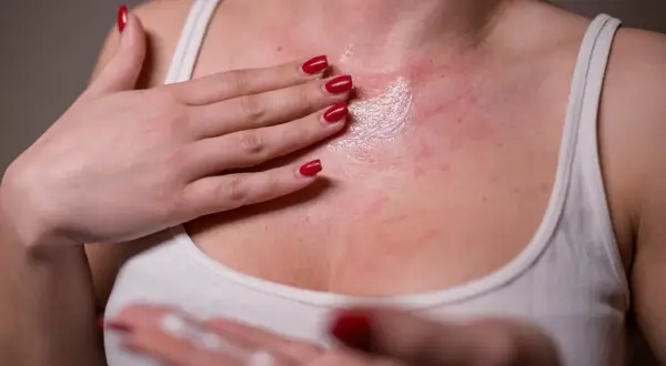 Rote Hautstellen und Juckreiz, mögliche Geraniol Allergie Symptome. Eine Hand trägt eine Salbe auf.