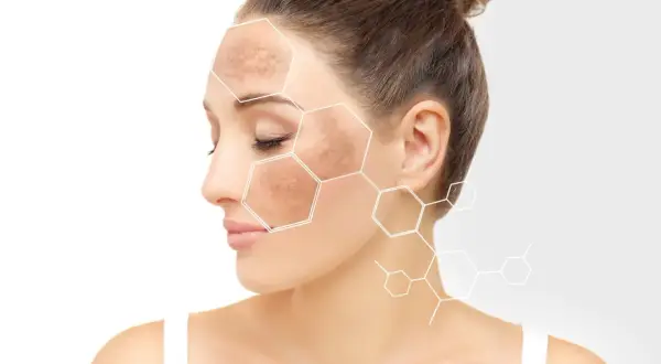 Mujer con manchas en la cara, destacadas con un patrón hexagonal.