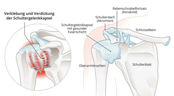 Schultergelenk mit verdickter Kapsel und entzündetem proc coracoideus. Veranschaulicht die Verklebung der Schultergelenkkapsel bei Frozen Shoulder.