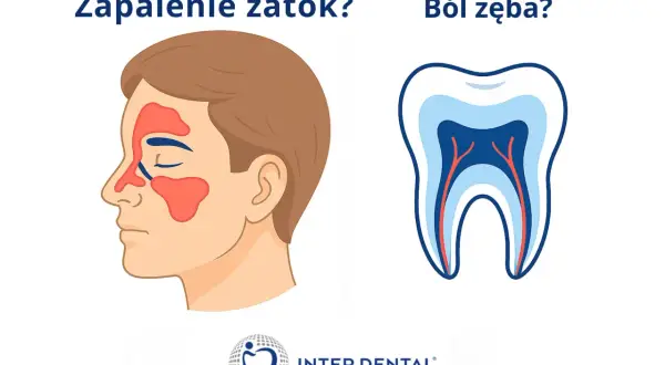 Zapalenie zatok czy nieokreślony ból zębów? Ilustracja porównuje obszary zatok z zapaleniem do przekroju zęba z widocznymi nerwami.