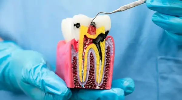 Model zęba pokazuje, ile kanałów ma ząb 2 górna. Widać próchnicę i narzędzie dentystyczne.