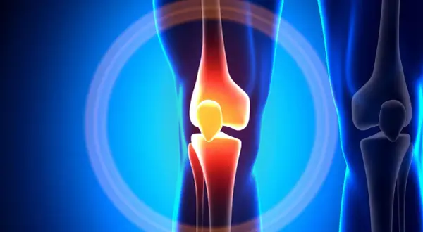 Schmerzendes Knie mit entzündeten Knochen, ein Symbol für die "unhappy triad" des Knies.