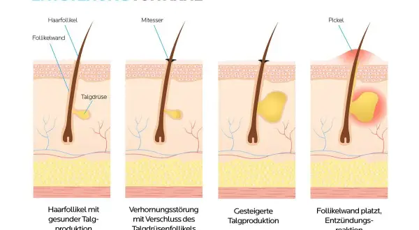 Illustrationen zeigen die Entstehung von Pickel Arten: gesunde Talgproduktion, Verhornungsstörung, gesteigerte Talgproduktion und Entzündungsreaktion.