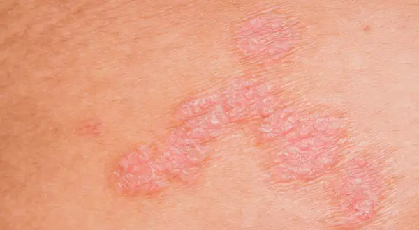 Nahaufnahme von **neurodermitis schuppiger haut**. Rote, erhabene Stellen mit silbrigen Schuppen auf der Haut.
