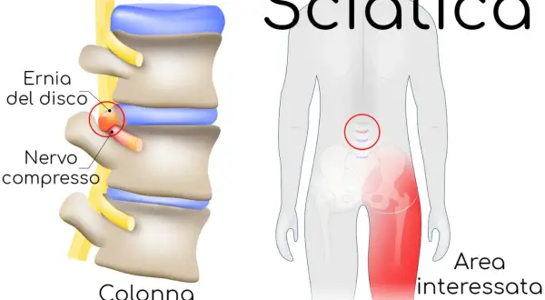 Illustrazione della colonna vertebrale con ernia del disco che comprime un nervo, causando dolore all'area interessata. La durata della sciatica varia.