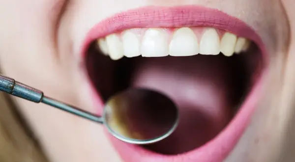 Usta z różową szminką, białe zęby i lusterko dentystyczne. Czy to początek leczenia zatrucia zęba na 3 miesiące?