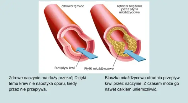 Porównanie zdrowej tętnicy z tą zwężoną przez płytki miażdżycowe. Układ krwionośny jest kluczowy dla zdrowia.