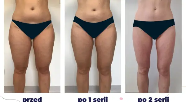Przed i po kriolipolizie: widoczne efekty wyszczuplenia ud po 1 i 2 seriach zabiegu.