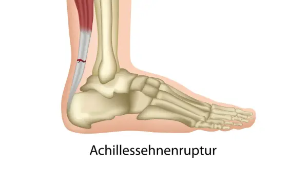 Achillessehnenruptur: Ein Riss in der Achillessehne, der durch Magnesiummangel begünstigt werden kann.