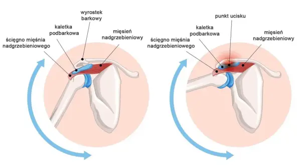 Ilustracja pokazuje test bolesnego łuku: zdrowy bark po lewej, a po prawej ucisk na ścięgno mięśnia nadgrzebieniowego.