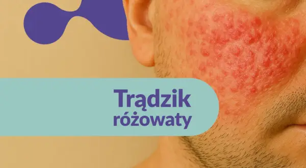 Skóra mężczyzny z widocznym trądzikiem różowatym na policzku. Czerwone, zapalne zmiany skórne.