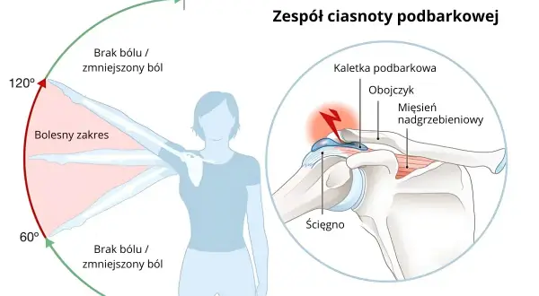 Ilustracja przedstawia zakres ruchu ramienia z zaznaczonym bólem oraz przekrój stawu barkowego z zaznaczonymi strukturami.