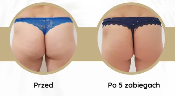 Widoczne **efekty endermologii** po 5 zabiegach: wygładzona skóra pośladków, redukcja cellulitu i poprawa jędrności.