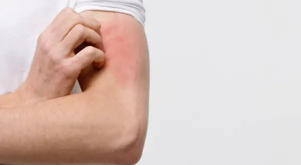Juckende Haut am Arm, rot und gereizt. Was tun bei Hautjucken?