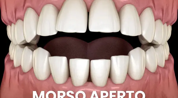 Denti bianchi e gengive rosa mostrano un morso aperto, con uno spazio evidente tra gli incisivi superiori e inferiori.
