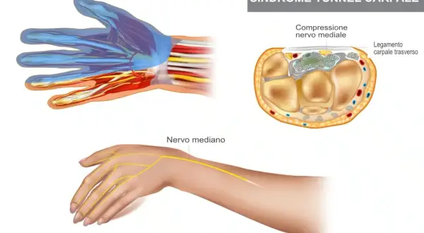 Illustrazione sindrome tunnel carpale: anatomia mano, nervo mediano compresso. Valutare ghiaccio o calore per alleviare il dolore.