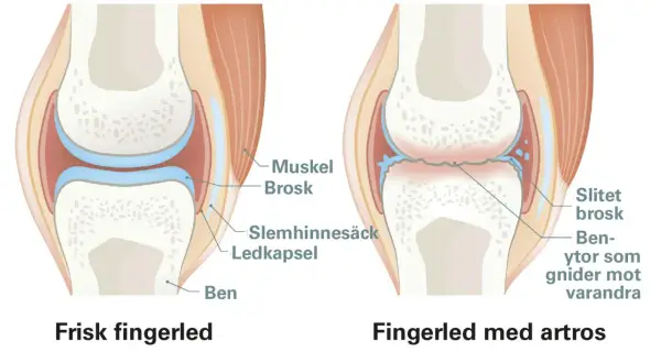 Jämförelse av frisk fingerled och fingerled med artros. Artros visar slitet brosk och benytor som gnider mot varandra, vilket kan förklaras med att osteofyter betyder benpålagringar.