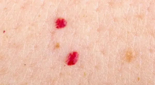 Dwa intensywnie czerwone pieprzyki na jasnej skórze, otoczone drobnymi naczynkami i innymi, jaśniejszymi znamionami.