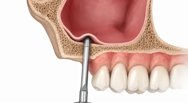 Ilustración de elevación de seno maxilar, mostrando un instrumento dental elevando la membrana sinusal para crear espacio para el injerto óseo.