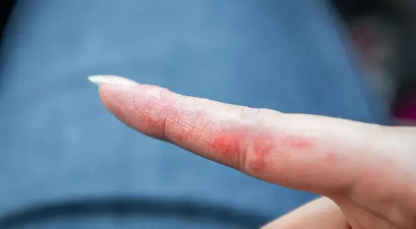 Alergia na nikiel w jedzeniu: objawy, diagnoza i dieta