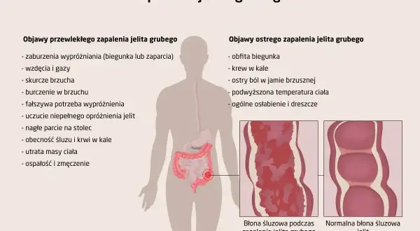 Ilustracja przedstawia objawy zapalenia jelita grubego, w tym wrzodziejące zmiany błony śluzowej.