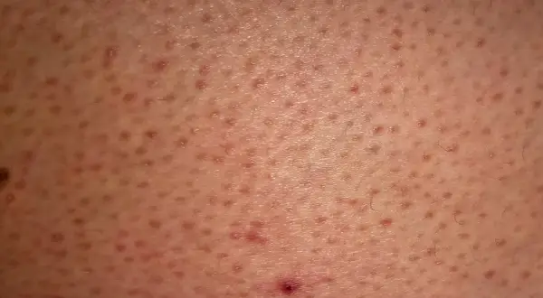 Skóra z licznymi drobnymi grudkami i zaczerwienieniami, charakterystycznymi dla rogowacenia mieszkowego (keratosis pilaris).