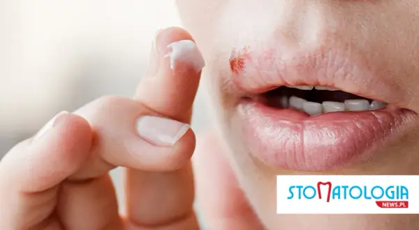 Masz opryszczkę przed dentystą? Sprawdź, kiedy możesz iść!
