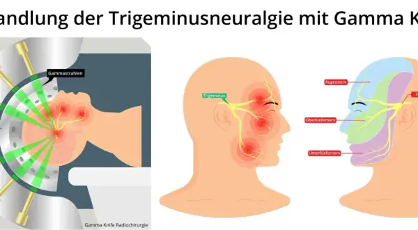 Darstellung der Gamma Knife Bestrahlung zur Behandlung von Trigeminusneuralgie. Grüne Strahlen zielen auf den Trigeminusnerv.