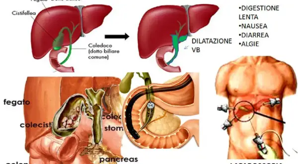 Illustrazione della sindrome post-colecistectomia, con diagrammi del fegato, cistifellea e vie biliari, e immagini di chirurgia laparoscopica. Vivere senza cistifellea può comportare disturbi digestivi.