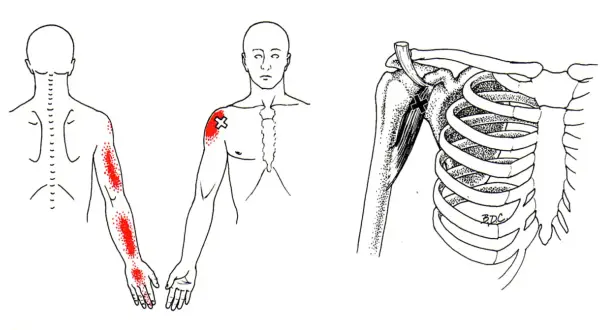 Schmerzpunkte am Arm und Schulterbereich, die auf den m coracobrachialis hinweisen. Detailansicht des Schultergelenks mit Muskeln und Rippen.