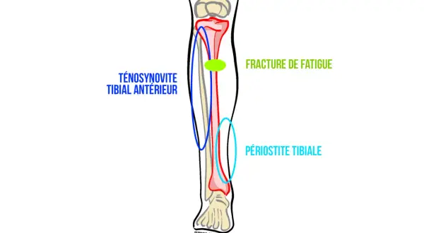 Schéma du tibia montrant les causes de douleur : fracture de fatigue, périostite tibiale et ténosynovite du tibial antérieur.