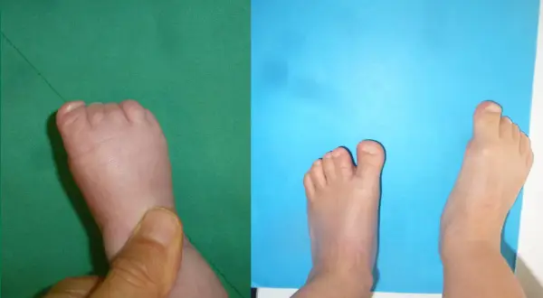Pied d'enfant présentant une syndactylie de l'orteil, où les orteils sont fusionnés.