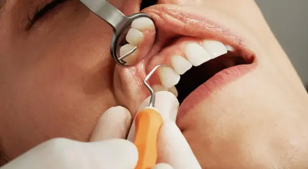 Zabieg stomatologiczny: czy po usuwaniu kamienia można jeść? Dentysta bada zęby pacjenta lusterkiem i narzędziem.