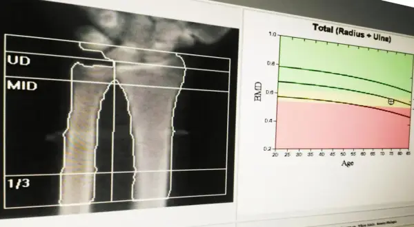 Wynik badania gęstości kości: analiza radiologiczna przedramienia z wykresem BMD w funkcji wieku.