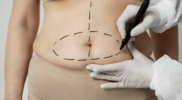 Liposukcja brzucha: Modelowanie czy odchudzanie? Poznaj prawdę!