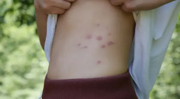 Picaduras de pulgas en humanos: síntomas, tratamiento y prevención eficaz