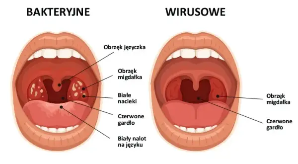 Jakie leki na anginę ropną? Skuteczne metody leczenia i ulgi