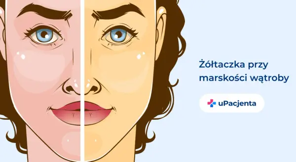 Twarz podzielona na dwie części: zdrową i zażółconą, ilustrująca żółtaczkę przy marskości wątroby.