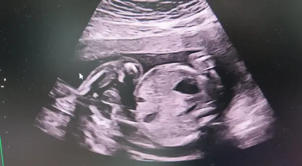 Ultraljud vecka 19 visar ett sovande barn. Ansiktet är tydligt, med en liten näsa och mun. Barnet har armarna uppdragna mot huvudet.