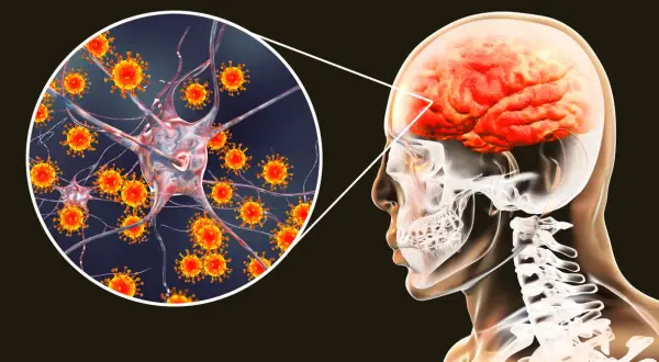 Ilustracja przedstawia wirusy atakujące neuron, co może prowadzić do kleszczowego zapalenia mózgu. Widoczny jest również przekrój głowy z mózgiem.