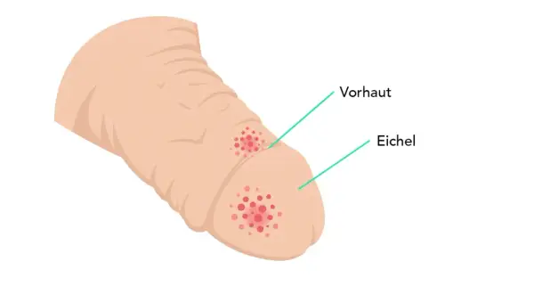Illustration zeigt rote Flecken auf Vorhaut und Eichel, die auf mögliche peniskarzinom bilder hinweisen könnten.