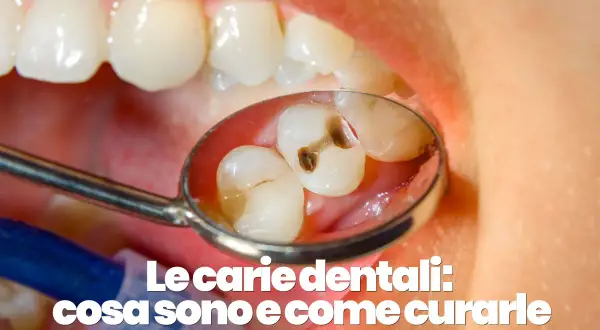 Dettaglio di denti con carie visibile in uno specchietto dentale. Scopri cosa sono le carie e come curare una carie a casa.