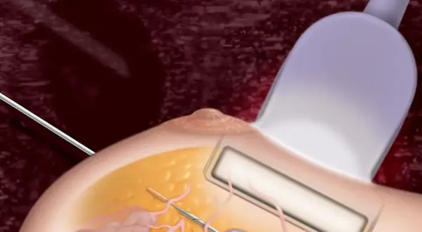 Ilustracja przedstawia biopsję piersi. Igła biopsyjna jest wprowadzana do tkanki piersi pod kontrolą ultrasonografu.